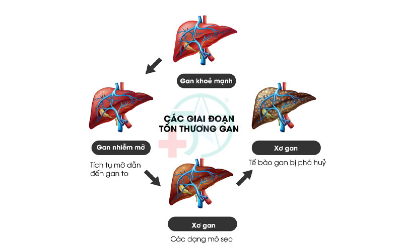 dau-hieu-benh-gan-cac-giai-doan-ton-thuong-gan
