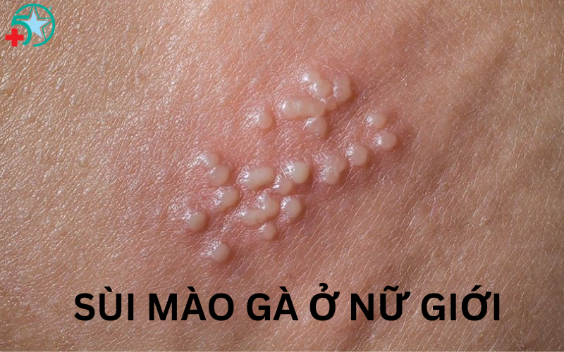 cach-chua-sui-mao-ga-o-vung-kin-nu (2)