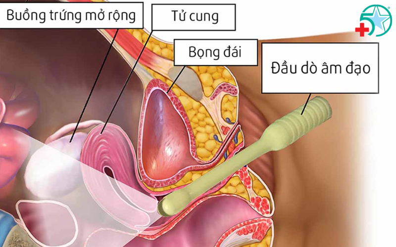 sieu-am-buong-trung-khi-nao (2)