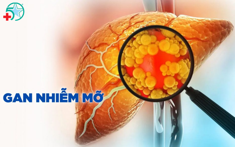 cach-dieu-tri-gan-nhiem-mo