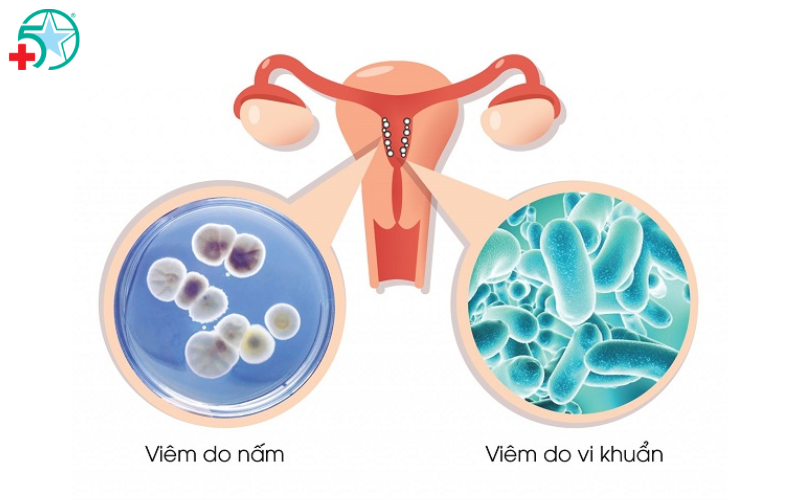 cach-tri-viem-nhiem-phu-khoa-tai-nha