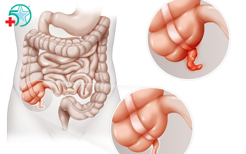 nguyen-nhan-gay-viem-ruot-thua