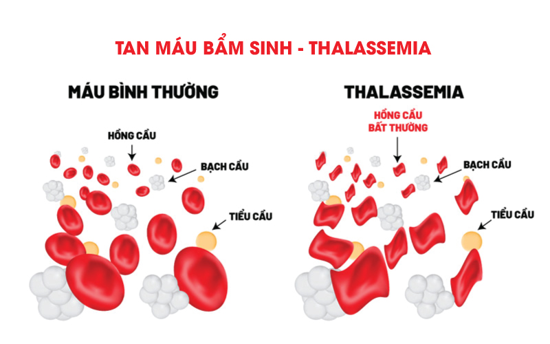 dau-hieu-benh-tan-mau-bam-sinh