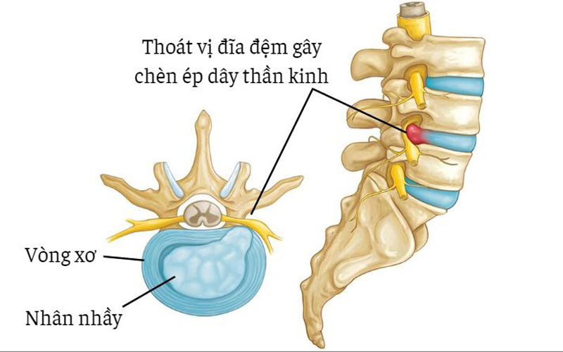 phong-ngua-dau-lung-duoi-do-ngoi-nhieu
