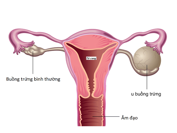 dau-hieu-u-buong-trung