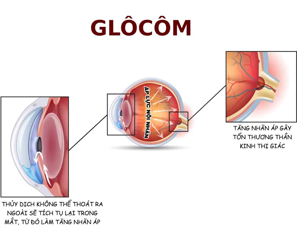glocom-la-benh-gi