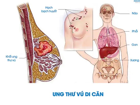ung-thu-vu-di-can