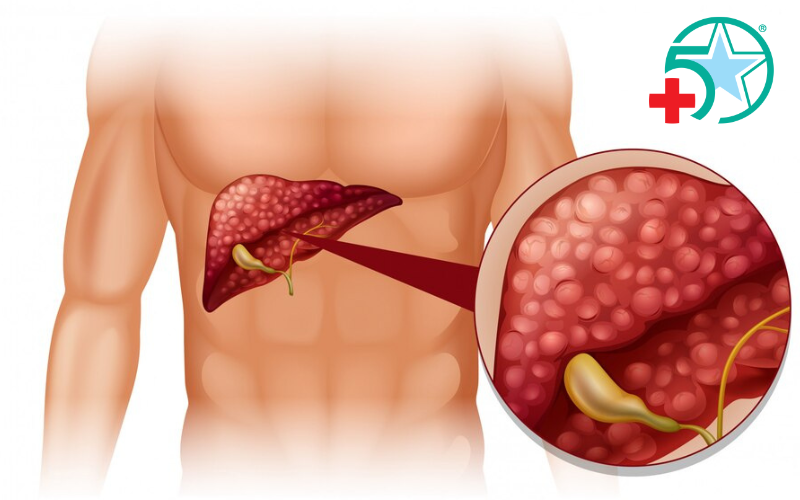 ung-thu-tuyen-tuy-kho-phat-hien-som