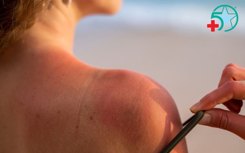 cham-soc-da-sau-chay-nang