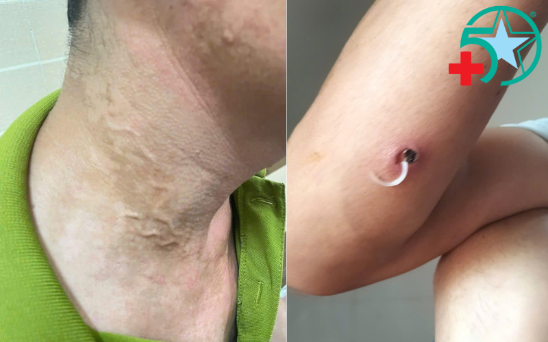 Benh-giun-rong-co-them-ca-nhiem-moi