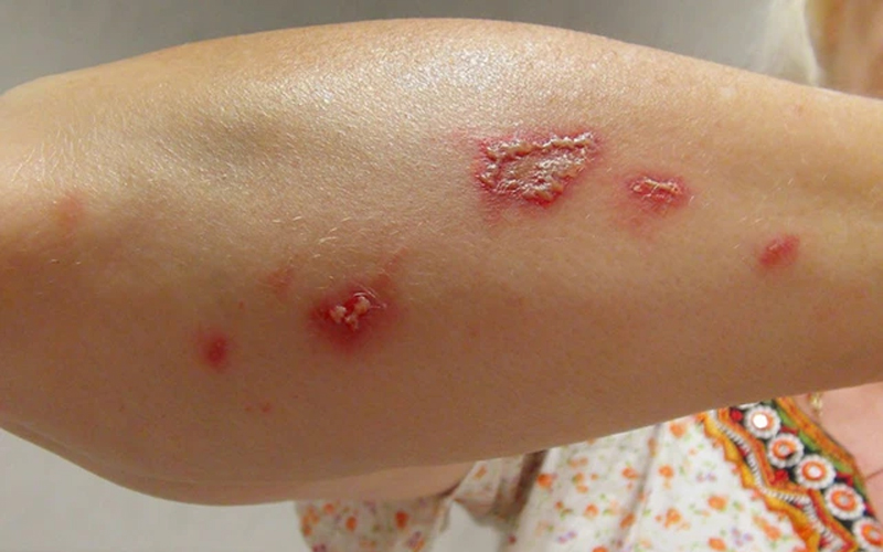 can-trong-benh-ve-da-do-con-trung-vao-mua-he