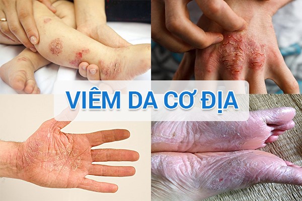 viem-da-co-dia-gay-kho-da