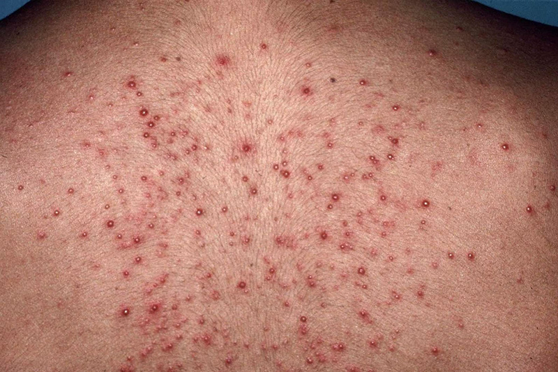 viem-da-mua-he-cach-nhan-biet-va-phong-ngua...