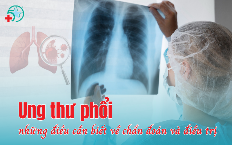 ung-thu-phoi-nhung-dieu-can-biet-ve-chan-doan