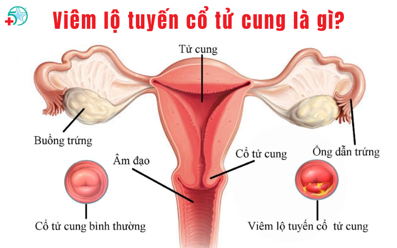 viem-lo-tuyen-co-tu-cung-hieu-de-dieu-tri-kip....