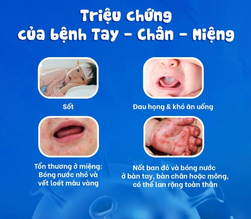 benh-tay-chan-mieng-cach-nhan-biet-som-phong-benh