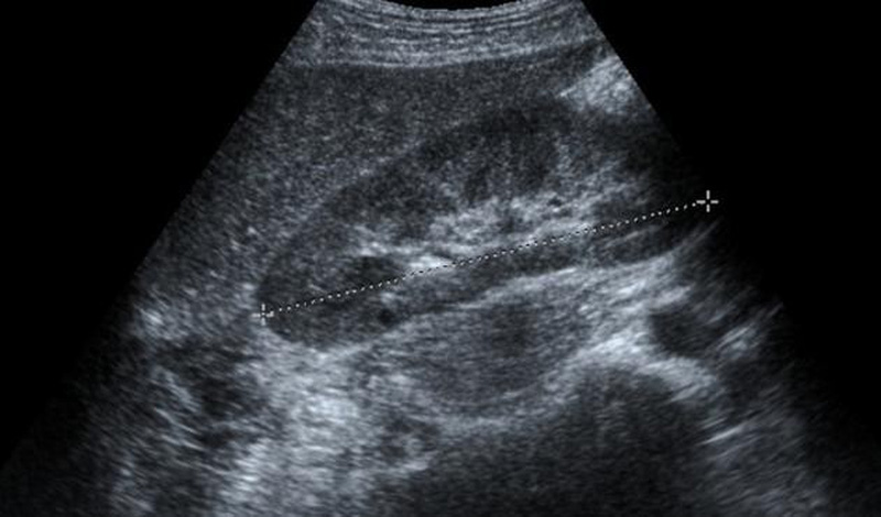 viem-gan-b-nguyen-nhan-trieu-chung-cach-dieu-tri