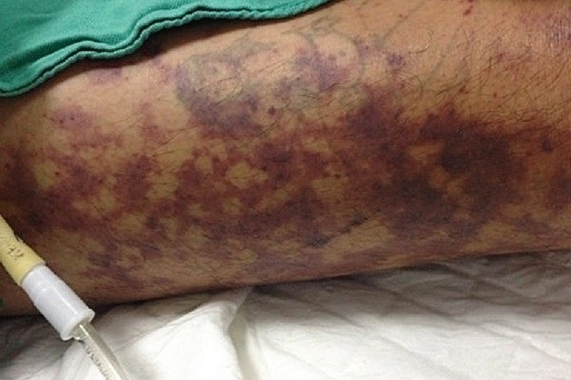 benh-lien-cau-lon-nguyen-nhan-trieu-chung-dieu...