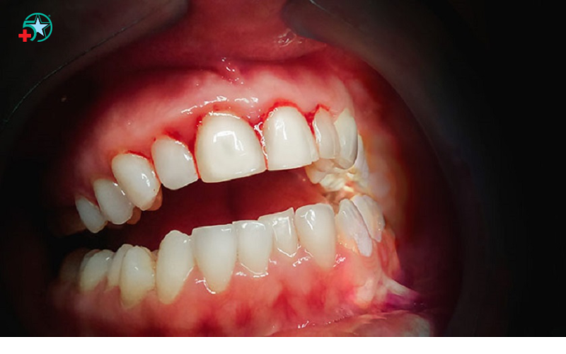 chay-mau-chan-rang-dau-hieu-canh-bao-suc-khoe...