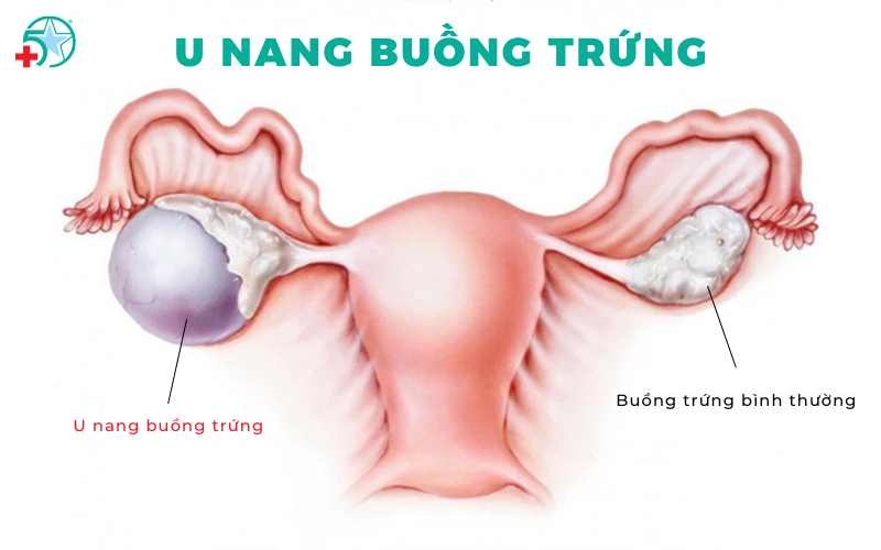 u-nang-buong-trung-co-nguy-hiem-khong-khi-nao-can