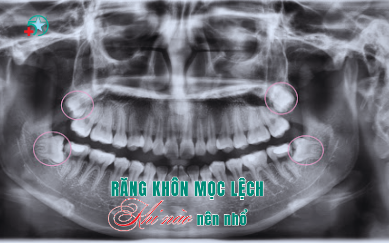 rang-khon-moc-lech-co-bat-buoc-nho-khong?