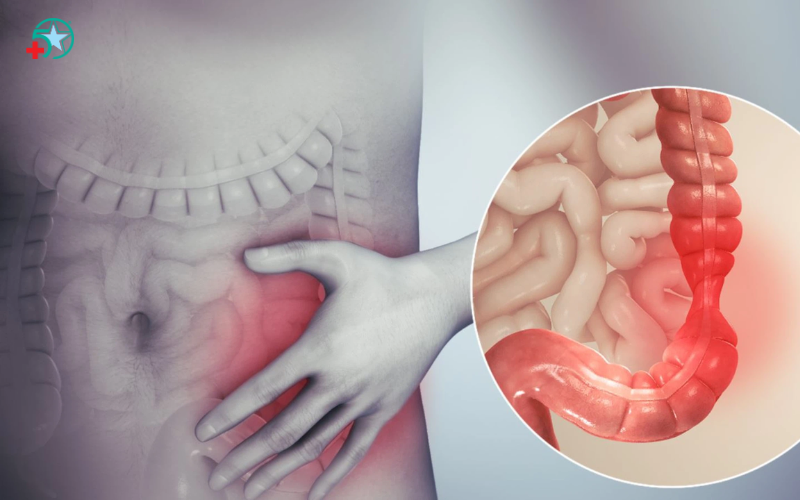 viem-dai-trang-co-that-benh-ly-de-nham-voi-roi...