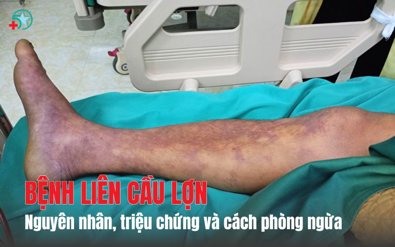 benh-lien-cau-lon-nguyen-nhan-trieu-chung-dieu...