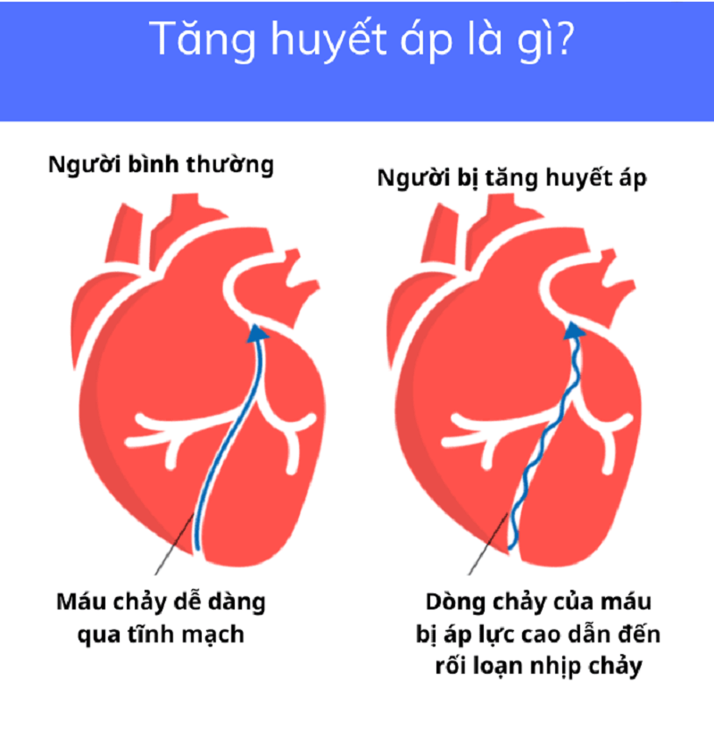 tang-huyet-ap-sat-thu-tham-lang-khong-nen-xem-nhe