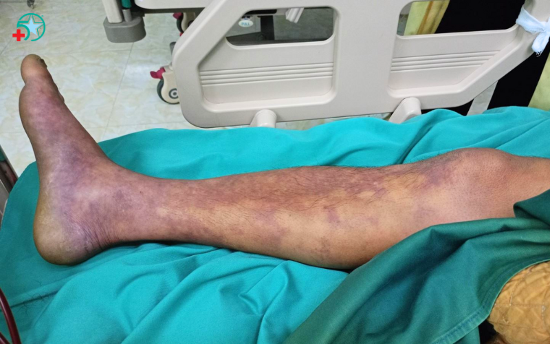 benh-lien-cau-lon-nguyen-nhan-trieu-chung-dieu...