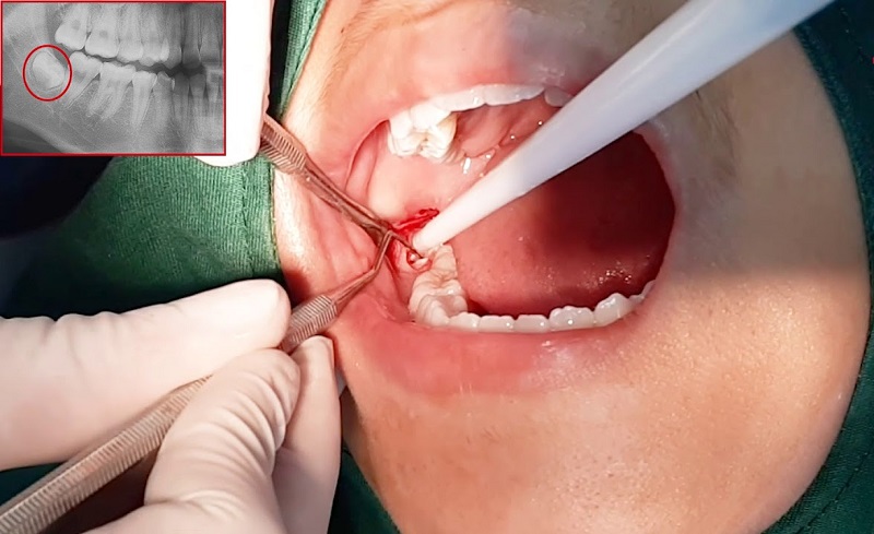 rang-khon-moc-lech-co-bat-buoc-nho-khong?