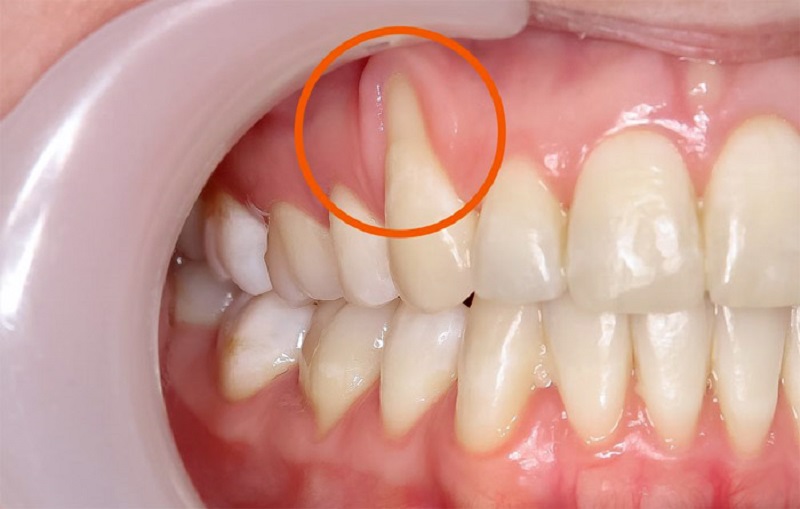 tut-nuou-nguyen-nhan-dau-hieu-va-cach-dieu-tri