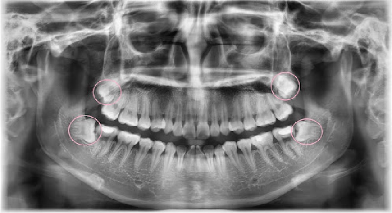 rang-khon-moc-lech-co-bat-buoc-nho-khong?