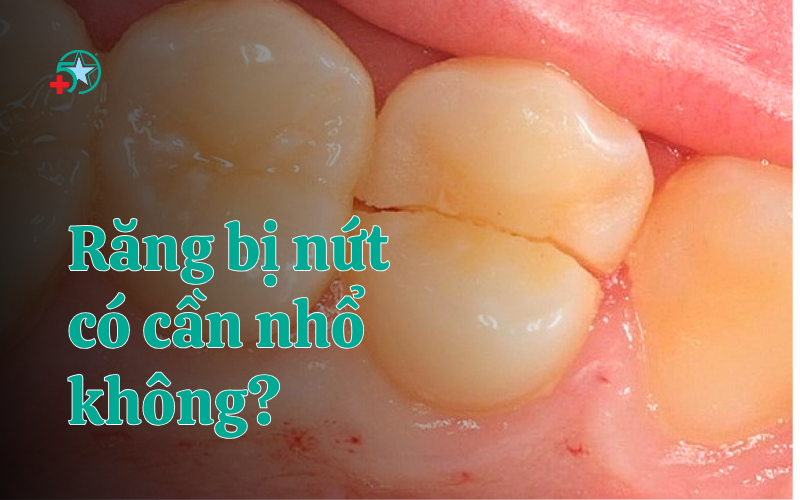 rang-bi-nut-co-can-nho-bo-khong-nguyen-nhan...