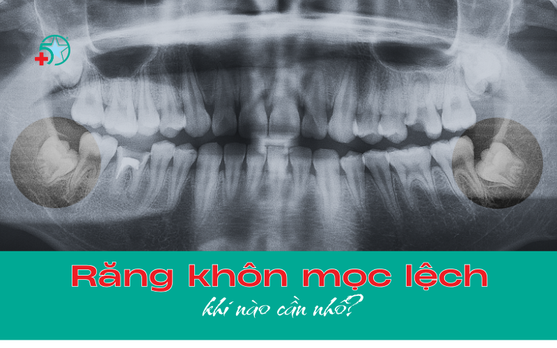 rang-khon-moc-lech-dau-hieu-nhan-biet-va-can-nho