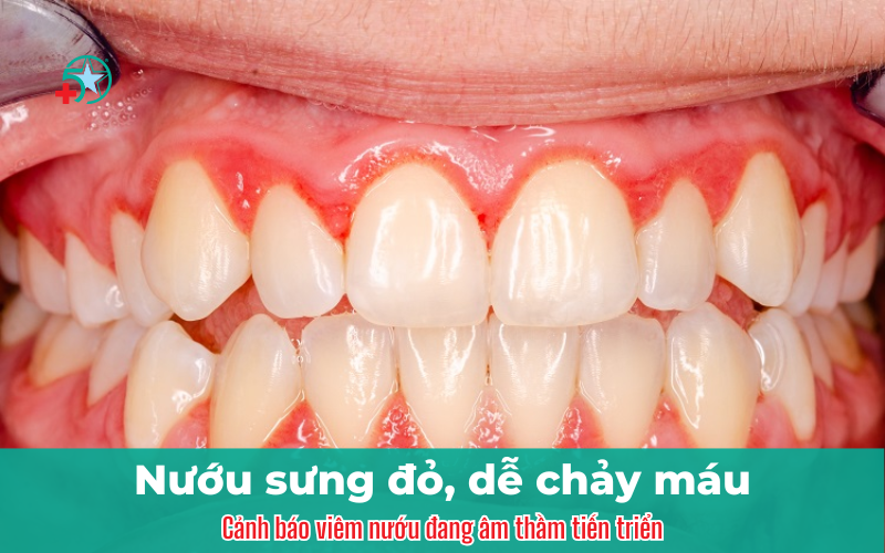 nuou-sung-do-de-chay-mau-canh-bao-viem-nuou...