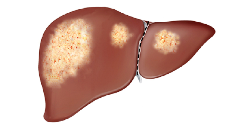gan-nhiem-mo-cap-do-1-co-can-dieu-tri-khong?