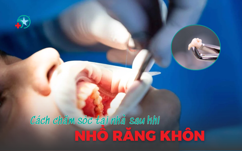 cham-soc-sau-khi-nho-rang-khon-huong-dan-tai-nha