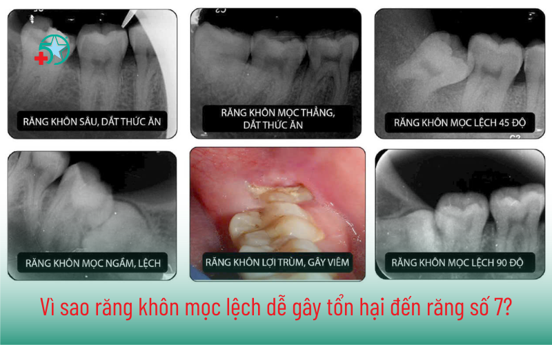 rang-khon-moc-lech-vi-sao-gay-ton-hai-den-rang-7