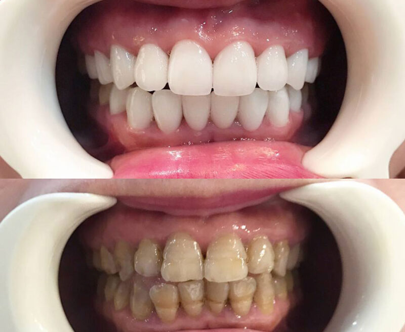 boc-rang-su-co-hai-cho-rang-that-khong-giai-dap..