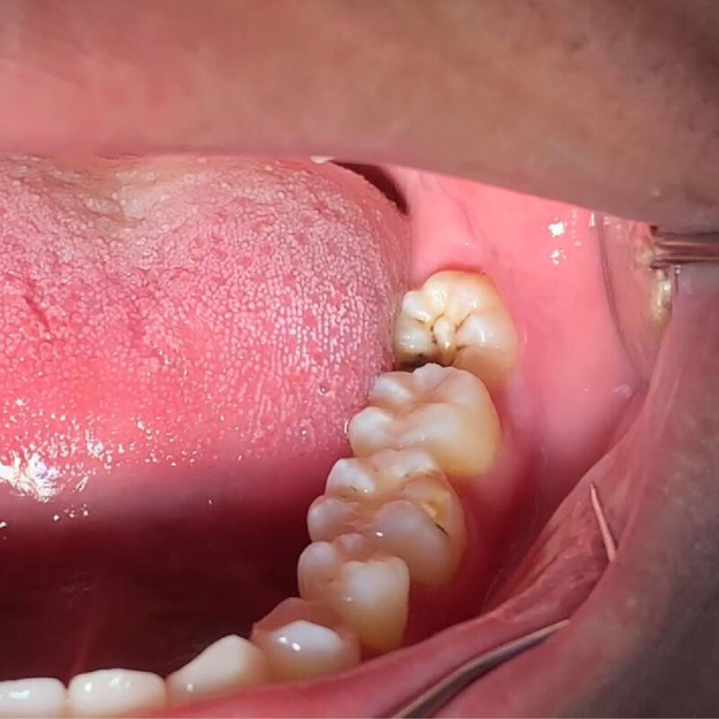 cham-soc-sau-khi-nho-rang-khon-huong-dan-tai-nha