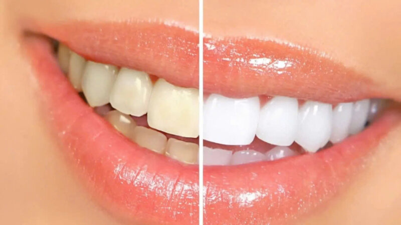 rang-su-bi-doi-mau-sau-thoi-gian-nguyen-nhan-va..