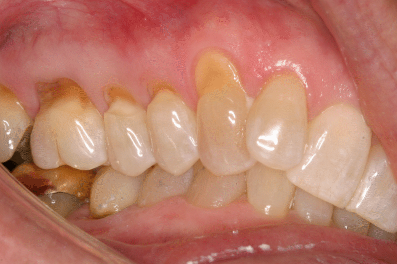 mon-co-rang-nguyen-nhan-dau-hieu-va-cach-dieu-tri