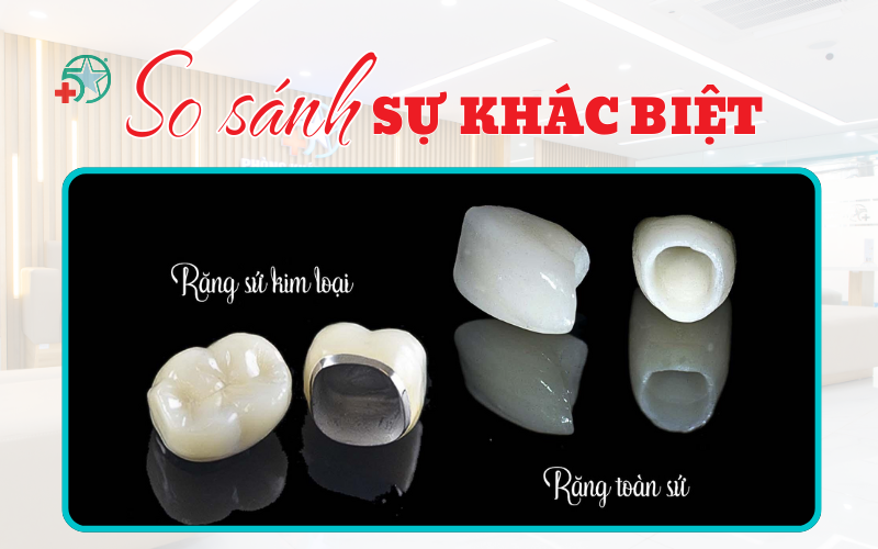 rang-su-titan-va-rang-toan-su-so-sanh-chi-tiet...