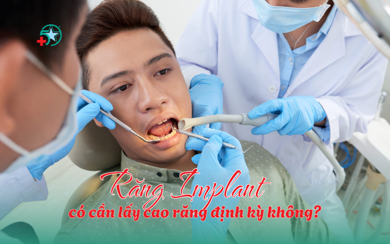 rang-implant-co-can-lay-cao-rang-khong-su-that...