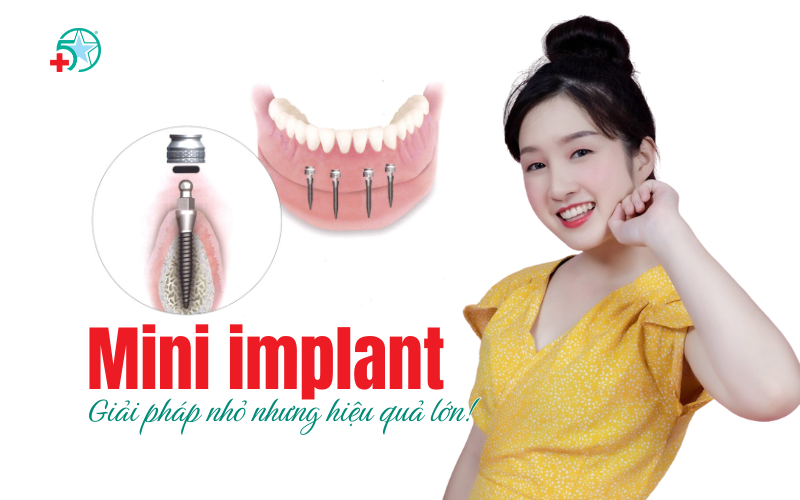 implant-mini-giai-phap-toi-uu-khi-mat-rang-vung..