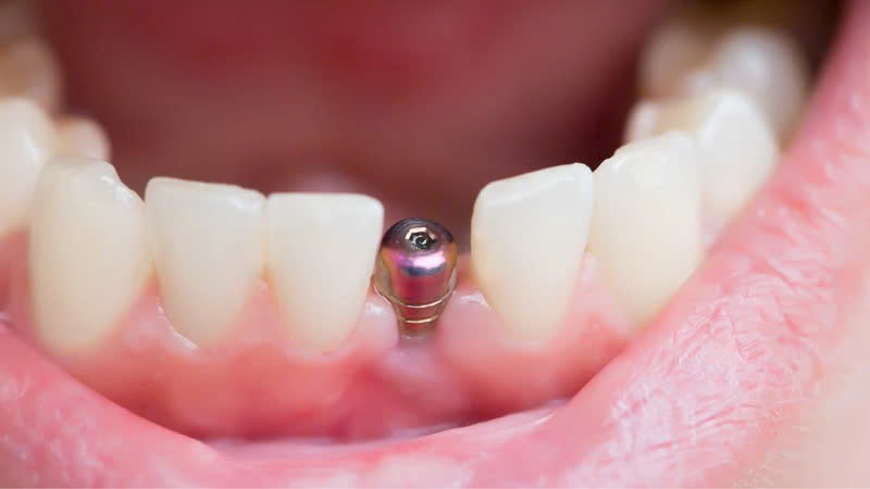 rang-implant-co-can-lay-cao-rang-khong-su-that...