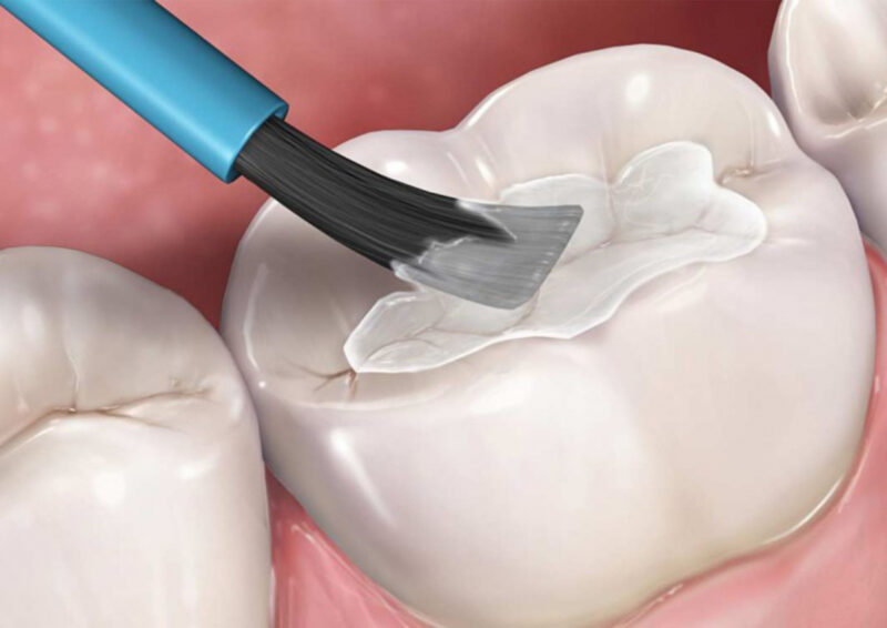 rang-nhay-cam-voi-do-nong-lanh-nguyen-nhan-trieu.