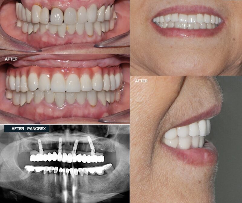 cay-ghep-implant-toan-ham-giai-phap-phuc-hoi-nu..