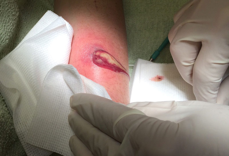 Khi nào người bệnh nên đi khám?Không phải lúc nào mụn nhọt cũng cần can thiệp y tế, nhưng có những trường hợp bạn tuyệt đối không được chậm trễ. Việc thăm khám sớm sẽ giúp hạn chế biến chứng và rút ngắn thời gian điều trị.Khi mụn nhọt đau nhiều, sưng to hoặc kéo dài hơn 3–5 ngày không giảm.
Khi xuất hiện sốt, ớn lạnh, mệt mỏi – dấu hiệu nhiễm trùng toàn thân.
Khi áp xe xuất hiện ở vùng mặt hoặc vùng nhạy cảm.
Khi ổ mủ tái phát hoặc xuất hiện ở nhiều vị trí.
Khi bạn có bệnh nền như tiểu đường, suy giảm miễn dịch.