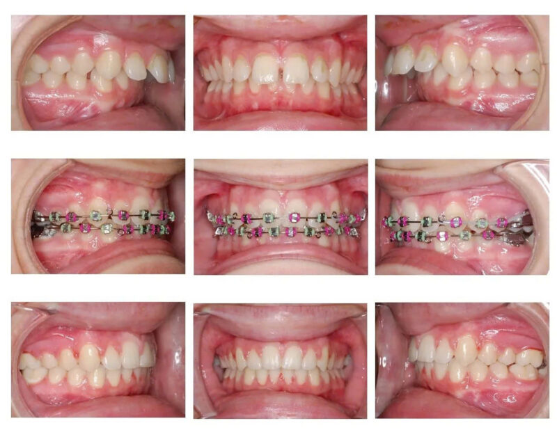 rang-ho-nhe-co-can-nieng-khong-hay-chi-can-boc-su